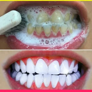 Dental Tartar & Stain Remover